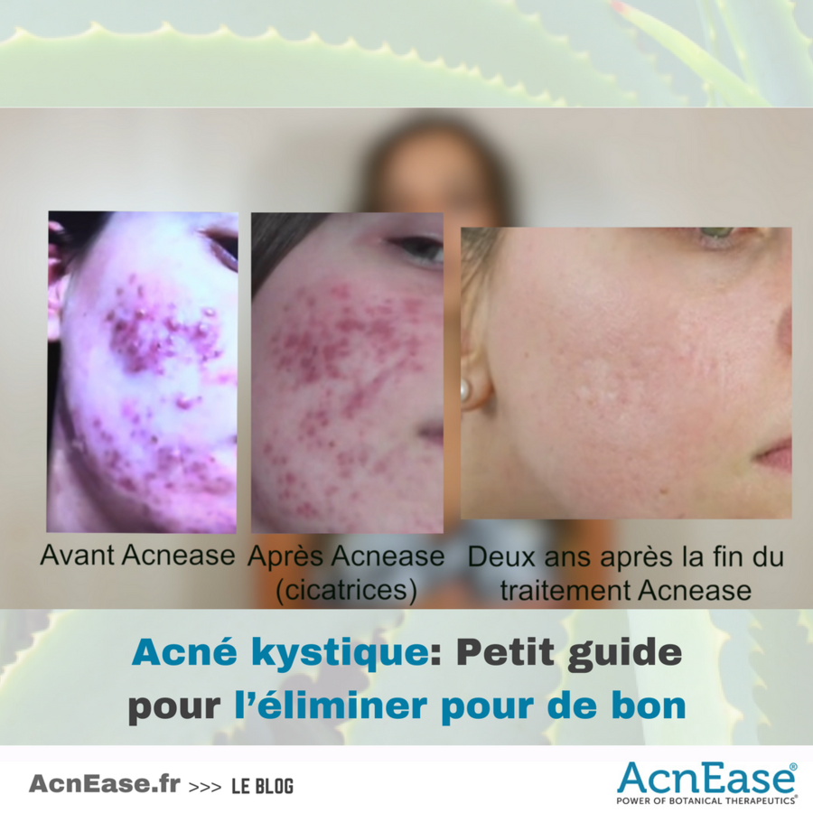 Acne Kystique Petit Guide Pour L Eliminer Pour De Bon Acnease